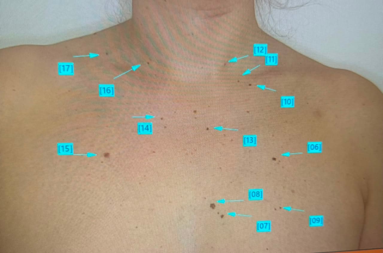 Dermatoscopía Digital – FotoFinder®