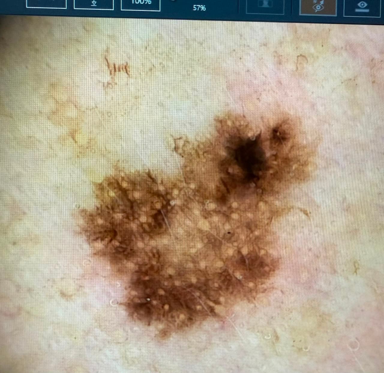 Dermatoscopía Digital – FotoFinder®