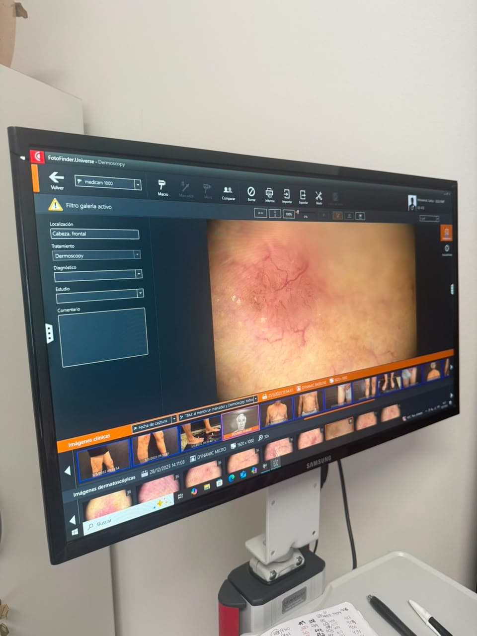 Dermatoscopía Digital – FotoFinder®